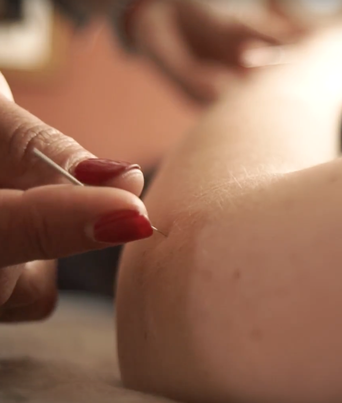 Closeup Image of Dr. Jill inserting needle into a pressure point on the arm of a patient