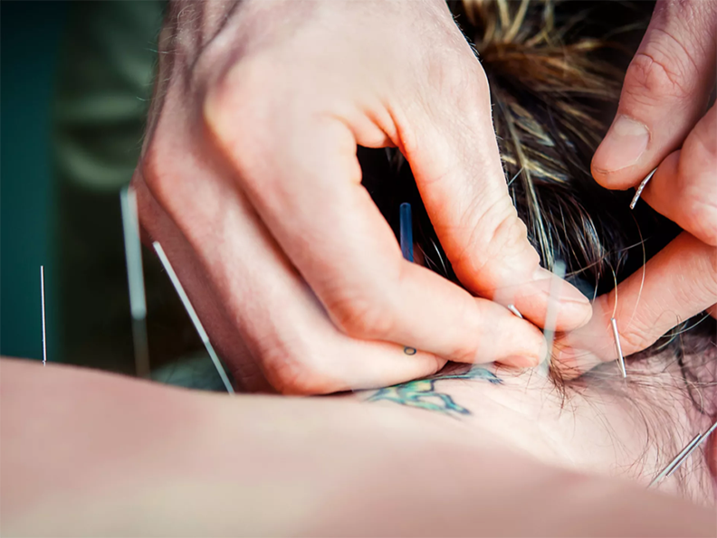 close up of hands inserting needles to back of patients neck